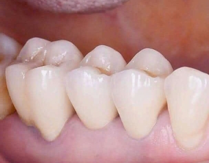 PHỤC HÌNH SỨ TRÊN CÙI GIẢ - CHỐT SỨ ZIRCONIA
