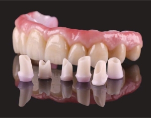 PHỤC HÌNH SỨ TRÊN IMPLANT