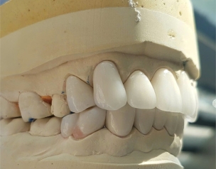SỨ ĐA LỚP MULTI 3D