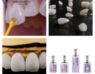 SỨ ÉP VENEER IPS EMAXCAD