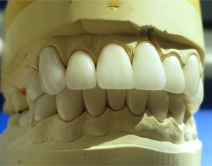 SỨ ZIRCONIA ĐẮP BỘT MEN VITA