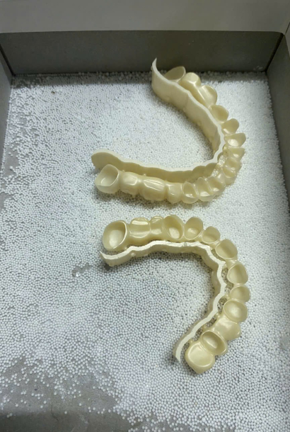 Sườn Đắp Sứ Hay Zirconia Nguyên Khối: Chọn Theo Vị Trí Răng Và Khoảng Mài