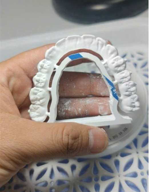 Sườn cầu 14 đơn vị Zirconia sau khi mill.