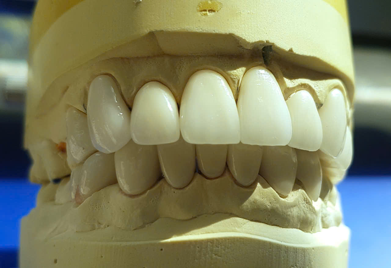 Răng sứ Zirconia nhìn chính diện trên mẫu hàm