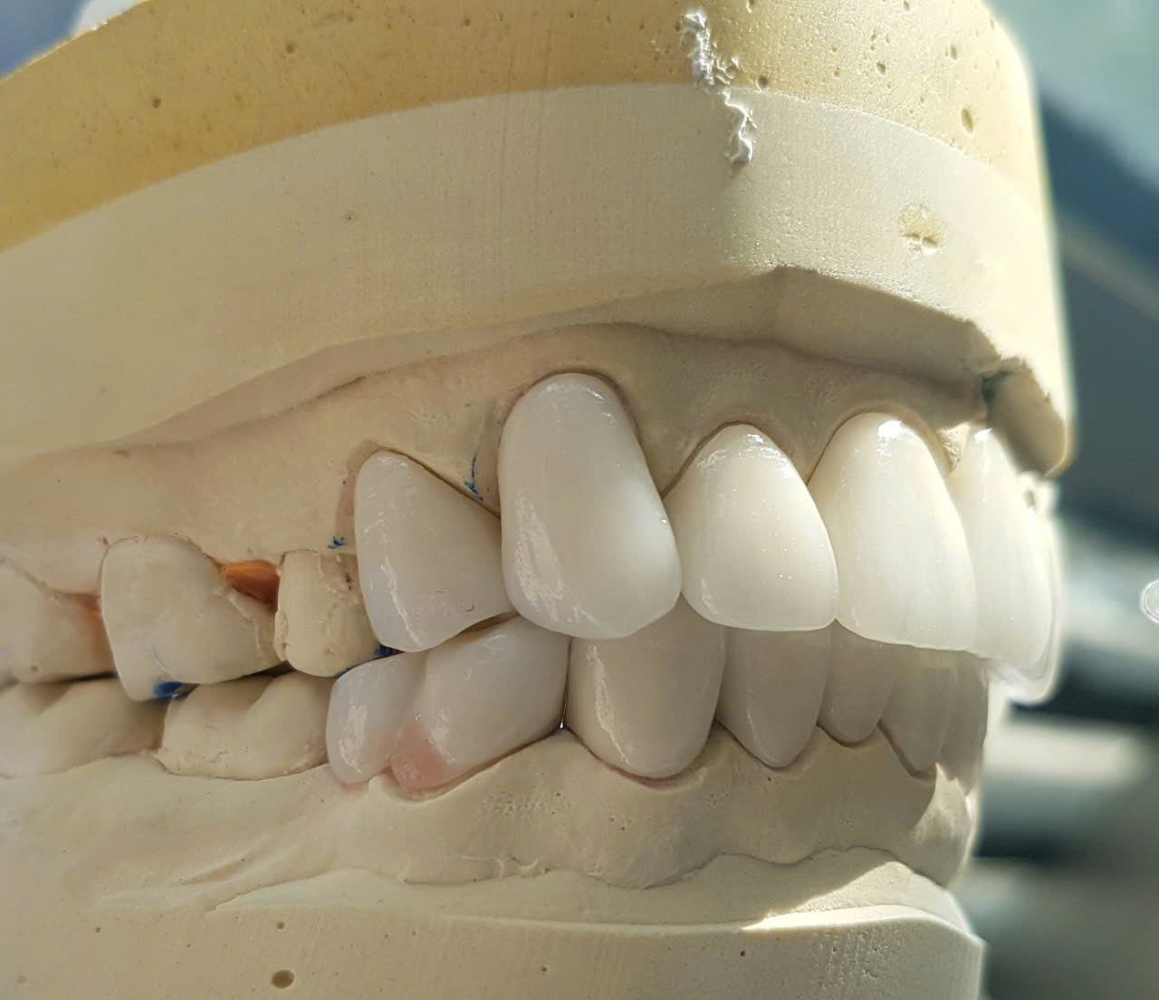 Răng sứ Zirconia nhìn góc nghiêng