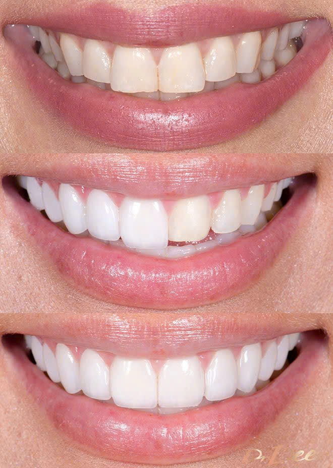So sánh nụ cười trước và sau khi phục hình răng sứ Zirconia