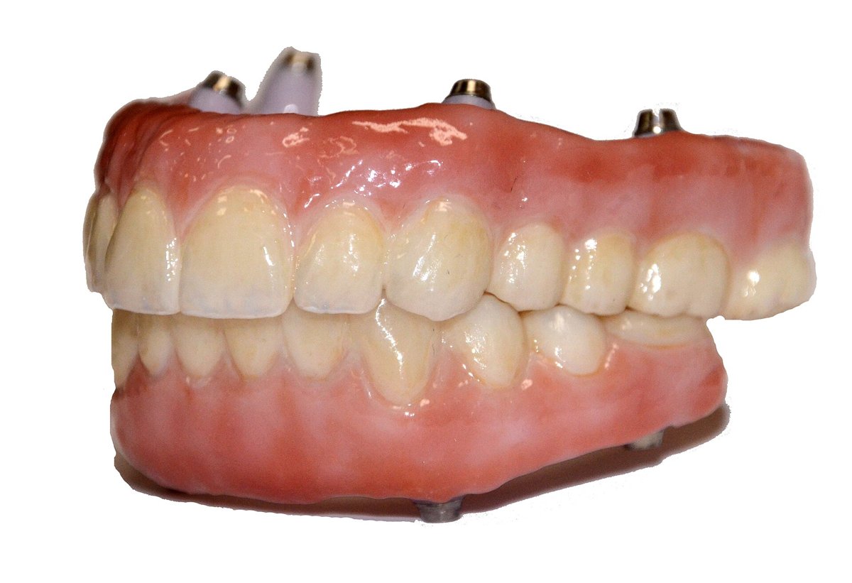 Ảnh minh hoạ cầu Zirconia toàn hàm nhiều đơn vị
