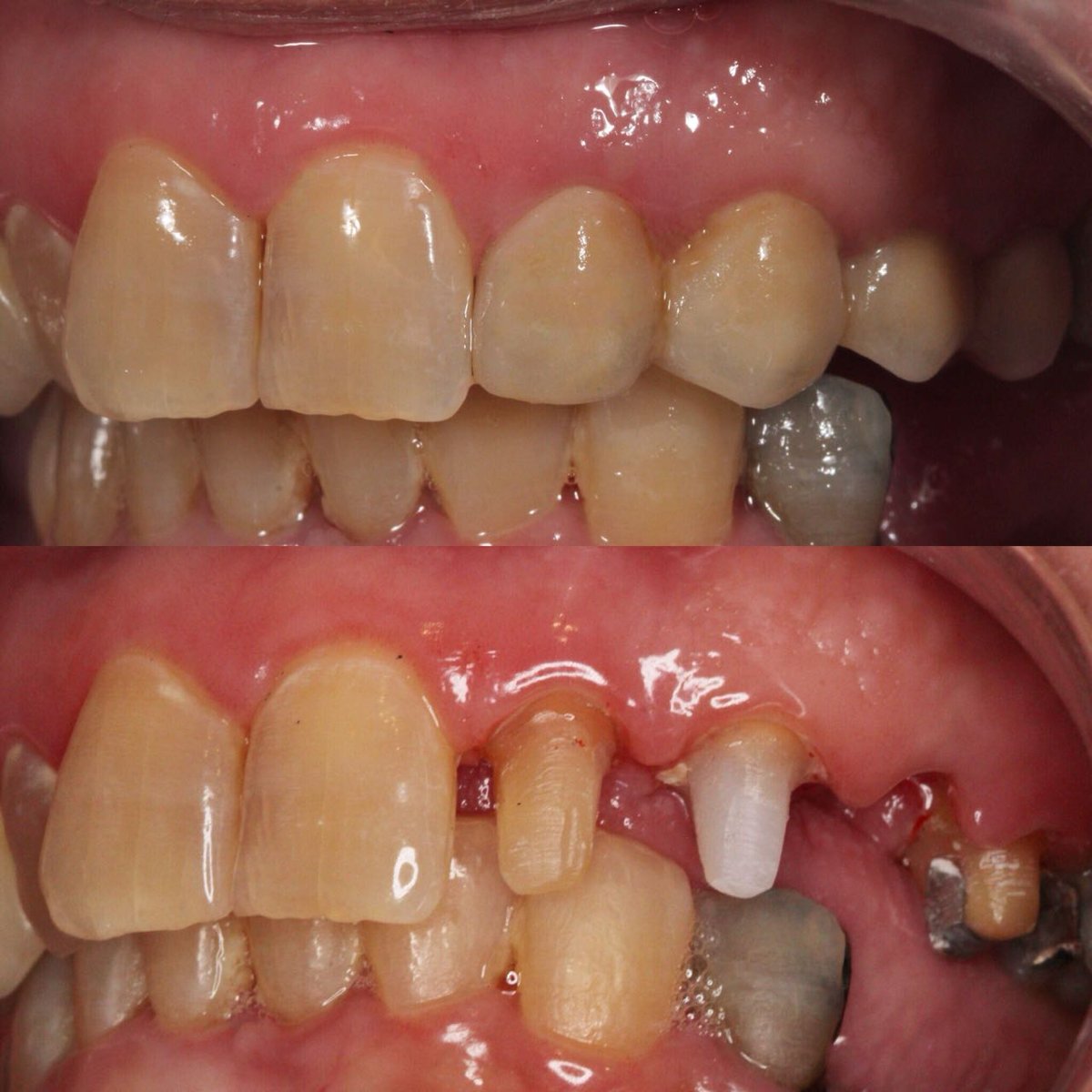 Ảnh minh hoạ cầu Zirconia trong miệng và các trụ sau khi mài