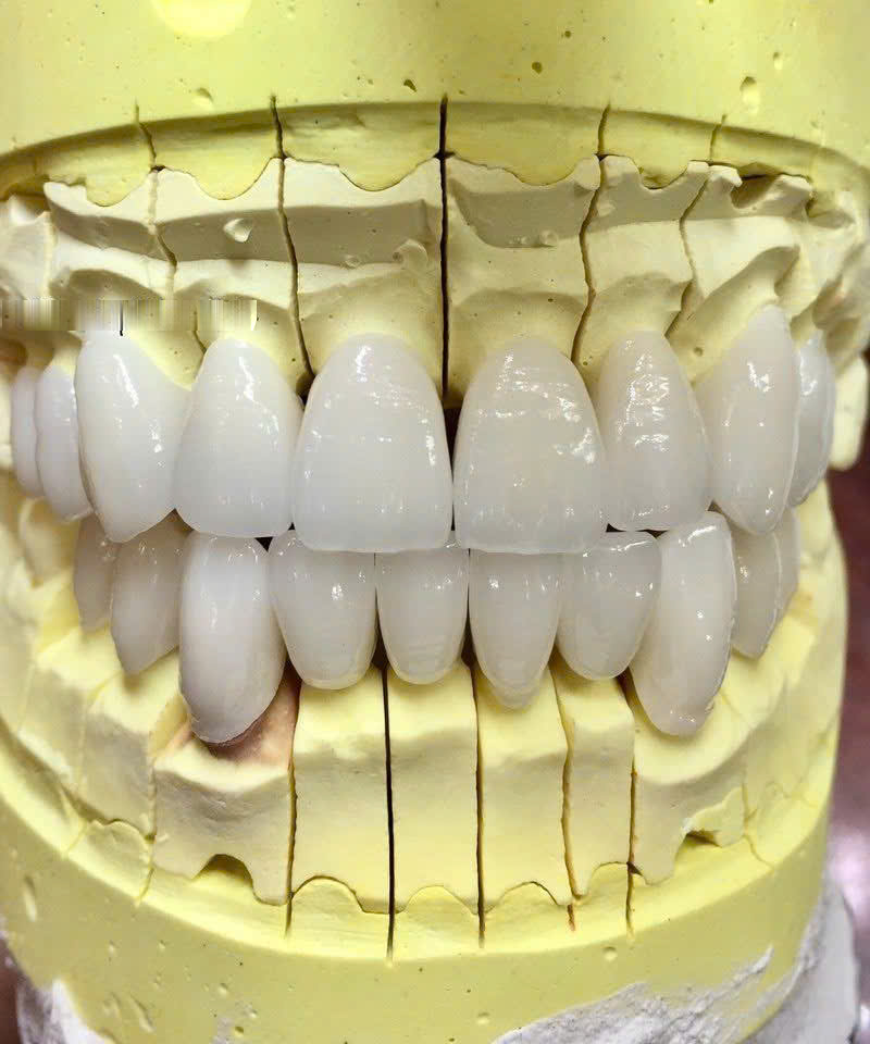 Răng sứ Zirconia nhìn chính diện trên mẫu hàm