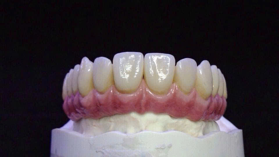 Phục hình sứ trên Implant tại KTSmile