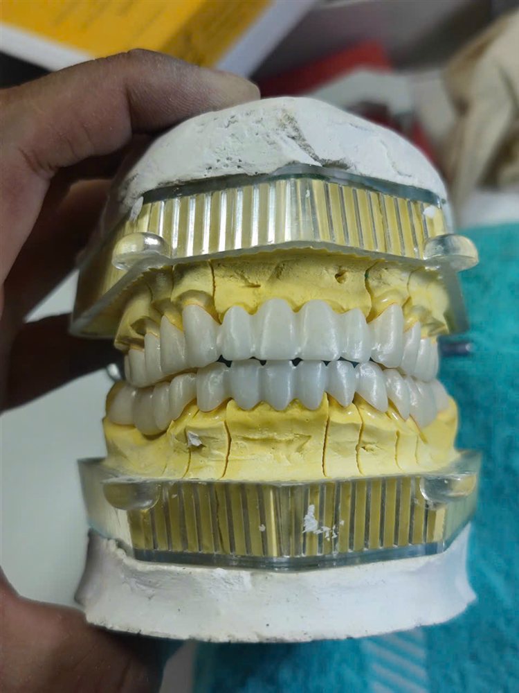 Phục hình sứ Zirconia lắp thử trên khớp cắn
