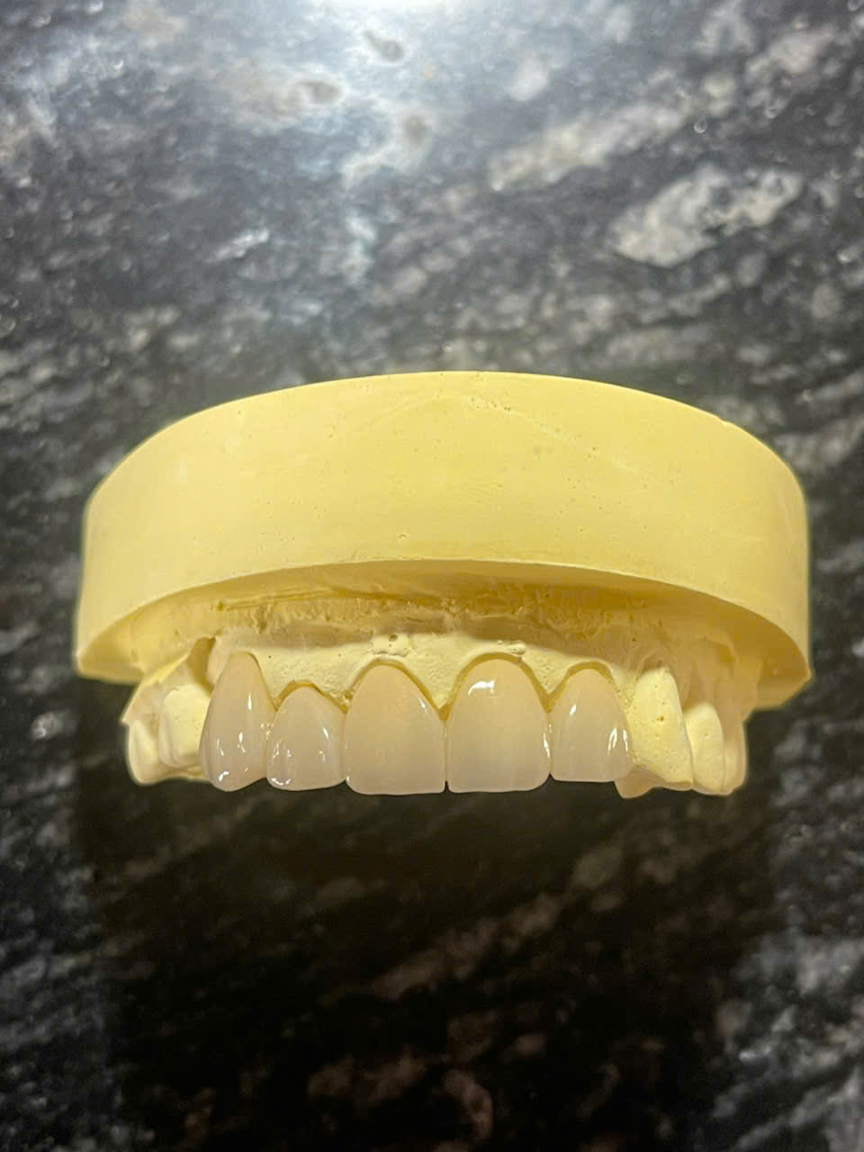Răng sứ Zirconia trên mẫu hàm trên