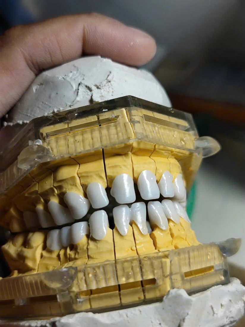 Phục hình toàn sứ Zirconia hoàn thiện trên mẫu hàm