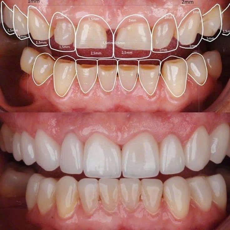 Thiết kế Smile Design