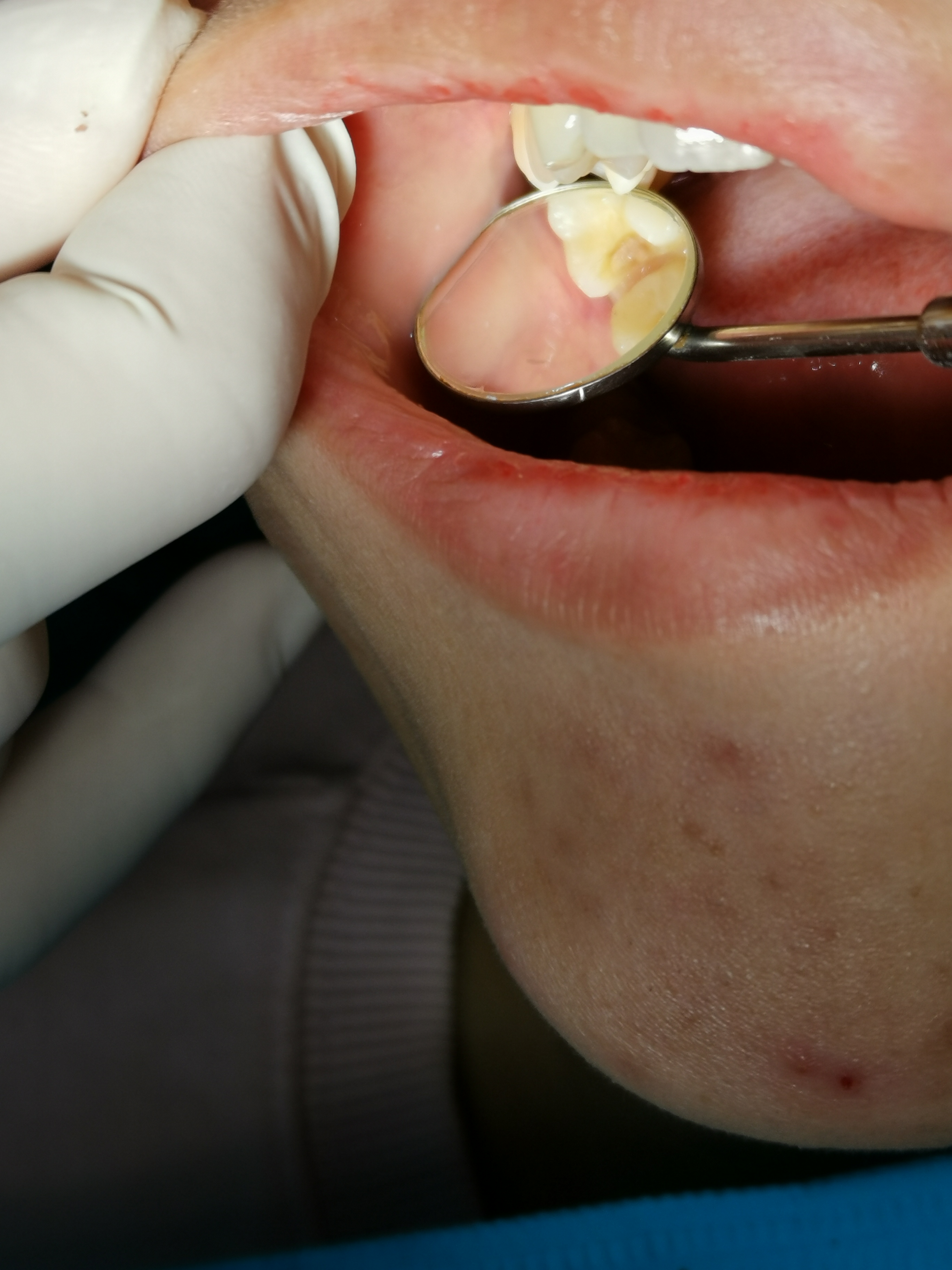 Phục hình răng sứ hoàn thiện trên miệng bệnh nhân