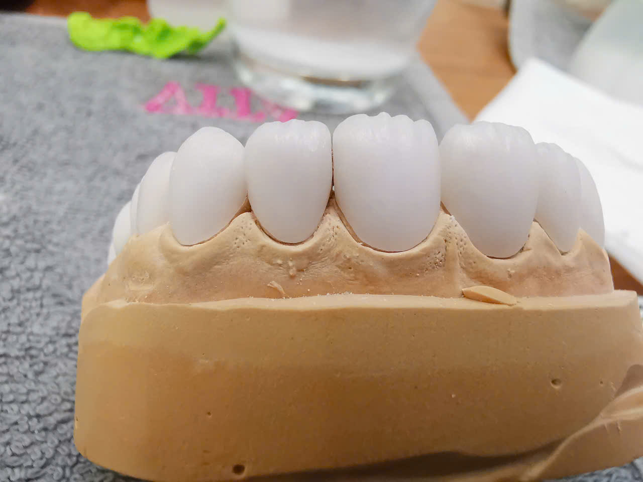 Sứ đa lớp Multilayer 3D tại KTSmile