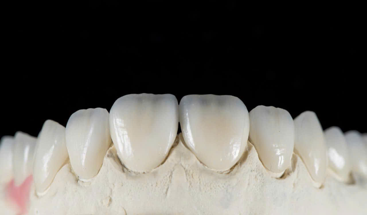 Sứ đa lớp Multilayer 3D tại KTSmile