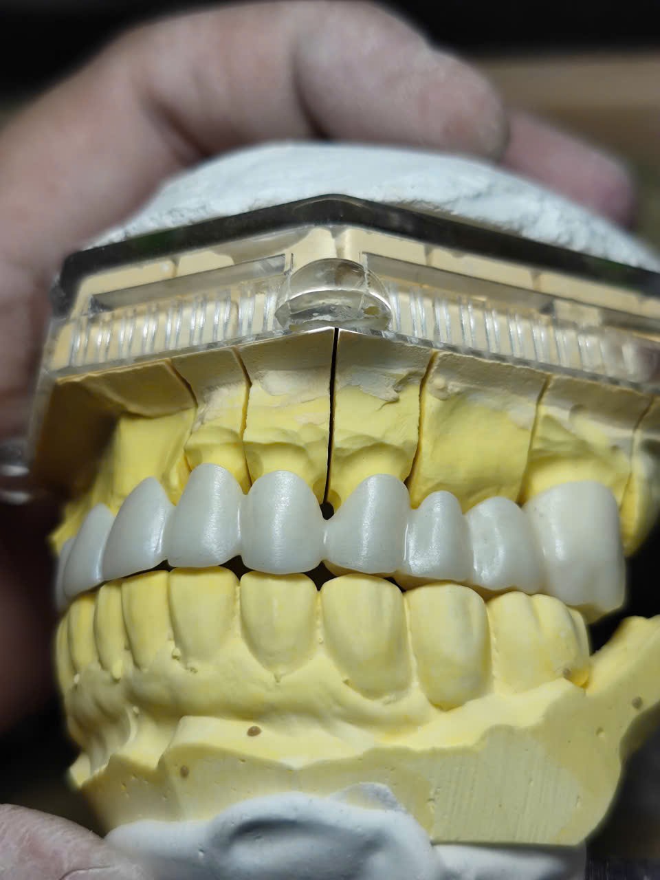 Sườn cầu Zirconia đặt thử ôm khít trên cùi răng của mẫu