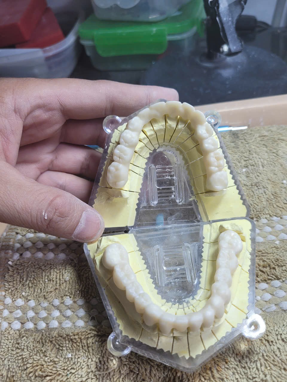 Sườn Zirconia toàn hàm đặt trên mẫu hàm sau khi phay và thiêu kết