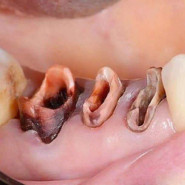 Răng sâu vỡ lớn chỉ còn chân răng