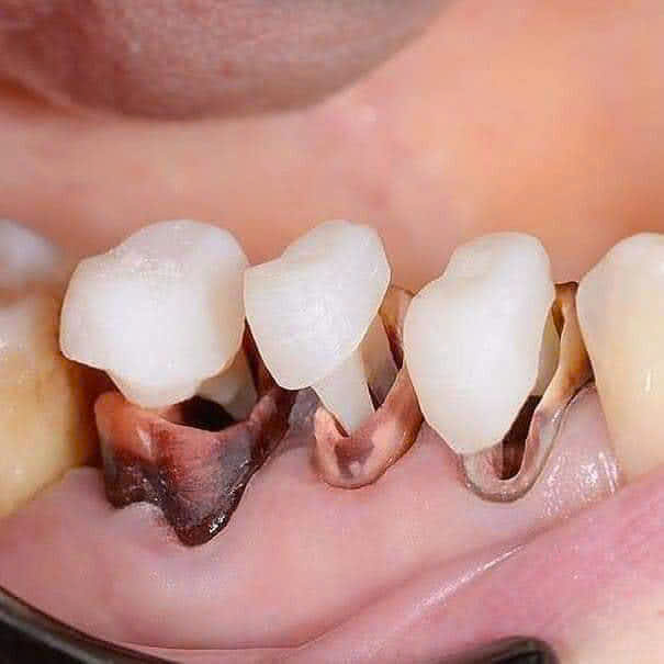 Dựng cùi giả – chốt sứ Zirconia trên chân răng