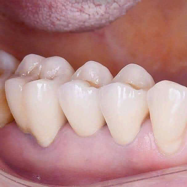 Phục hình mão sứ Zirconia hoàn thiện
